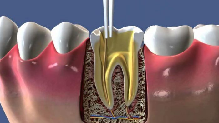 Endodontik tedaviler